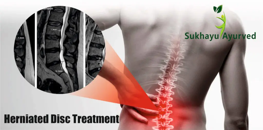 How to treat a herniated disc without surgery