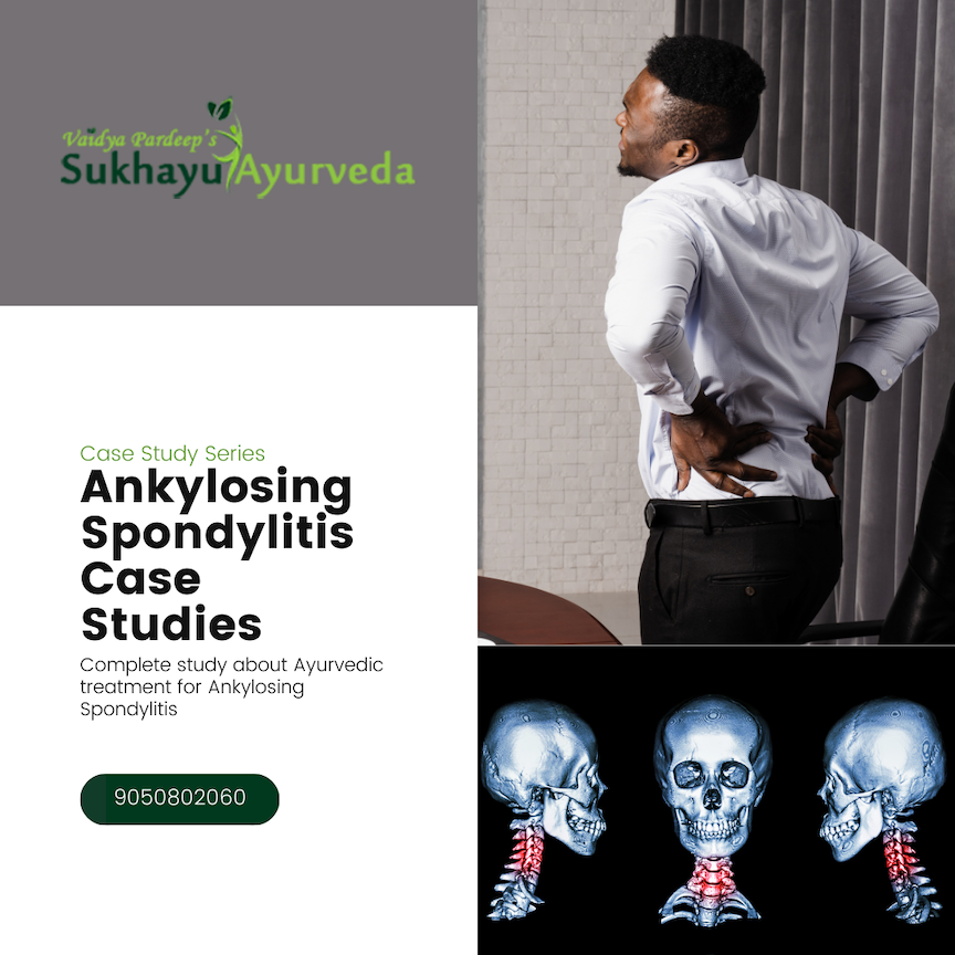 Case Series for Ankylosing Spondylitis Treatment through Ayurvda