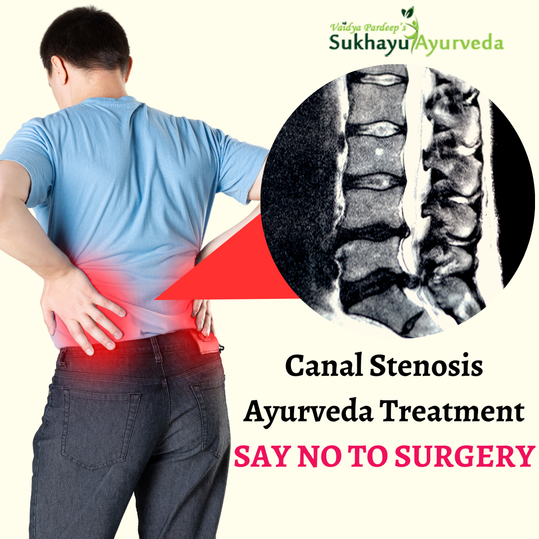 Without Surgery Spinal Canal Stenosis Treatment through Ayurveda